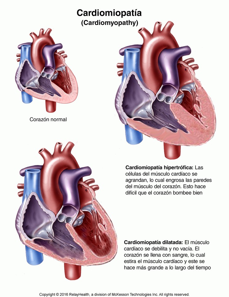 Cardiomyopathy: Illustration