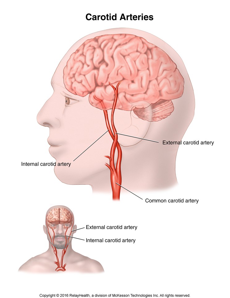 Carotid Arteries: Illustration