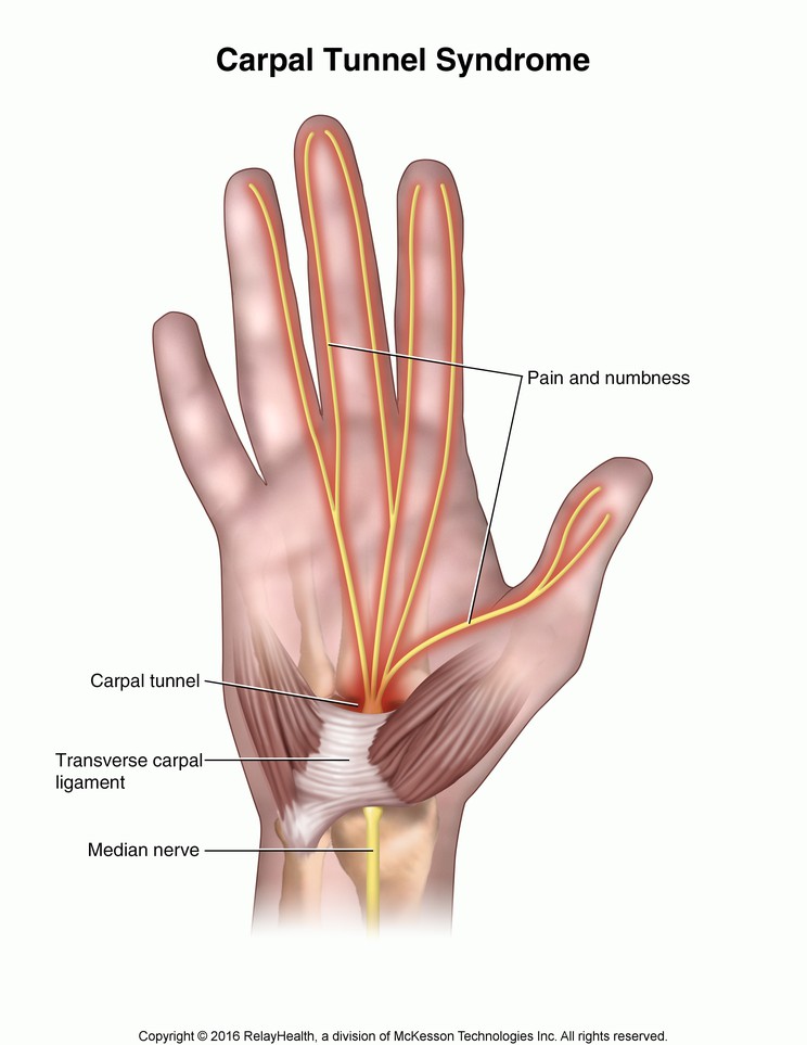 Carpal Tunnel Syndrome: Illustration