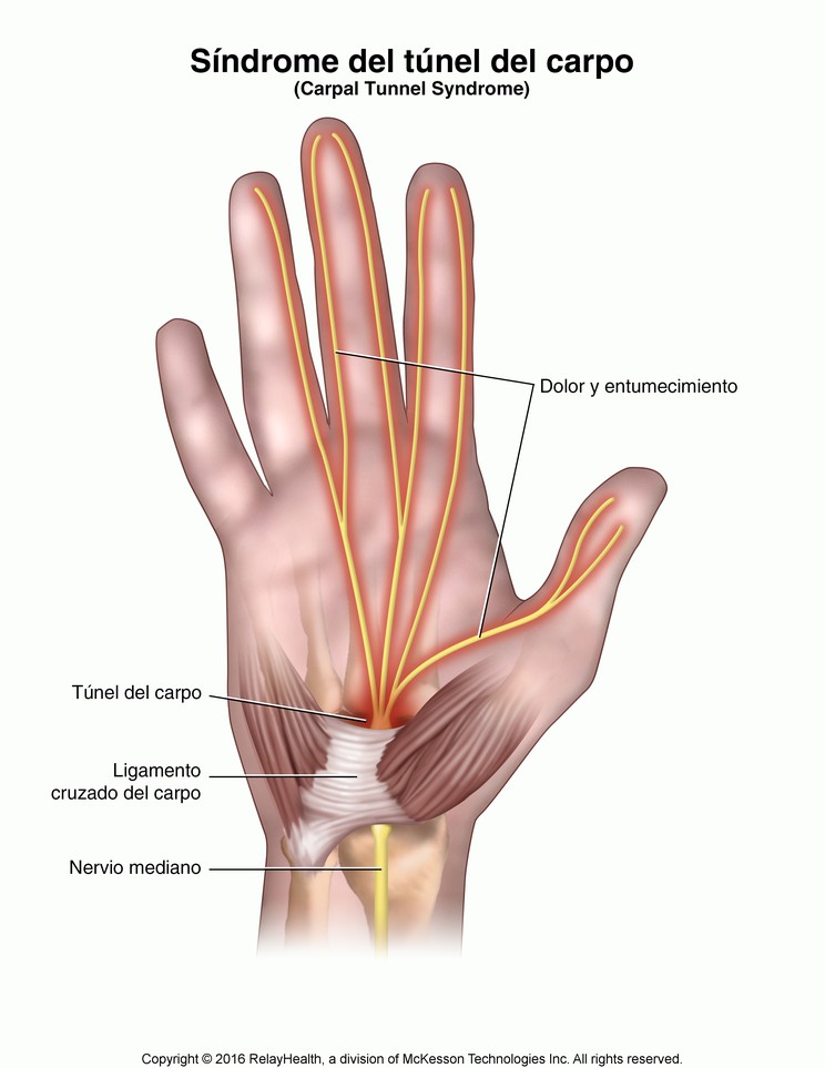 Carpal Tunnel Syndrome: Illustration