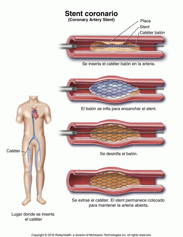Coronary Artery Stent: Illustration
