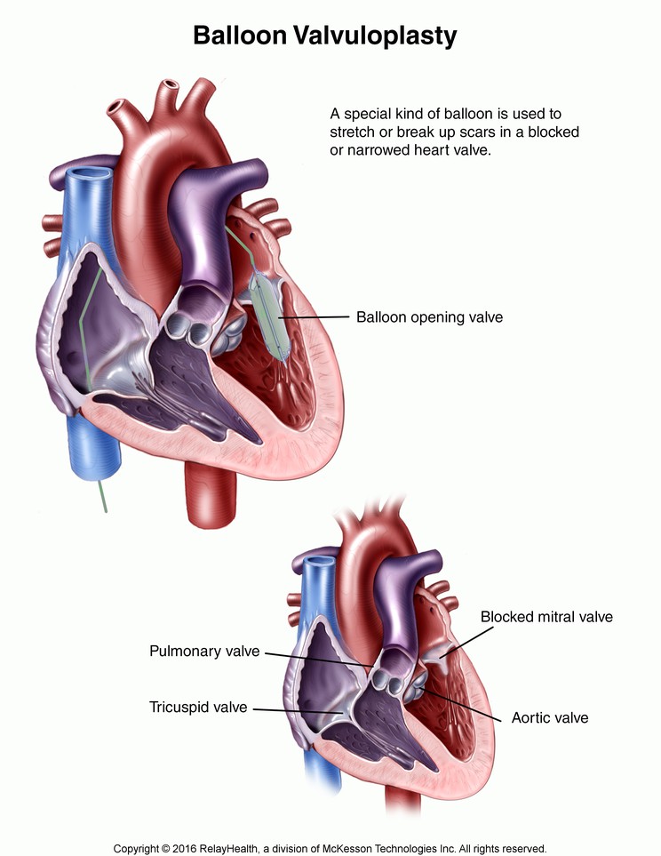 Balloon Valvuloplasty: Illustration