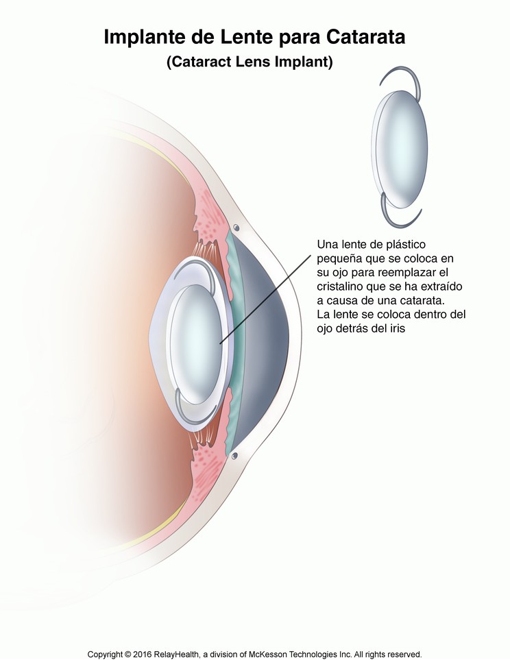 Cataract Lens Implant: Illustration