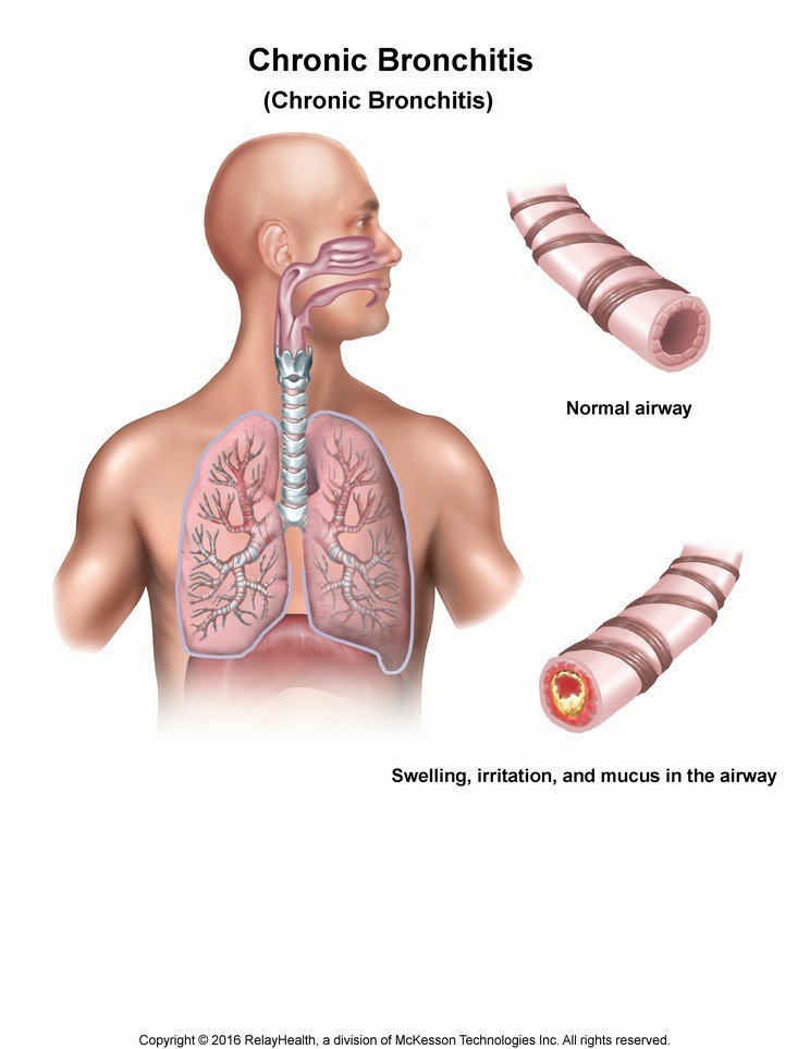 Chronic Bronchitis: Illustration