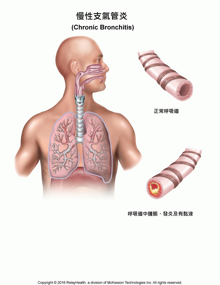 Chronic Bronchitis: Illustration