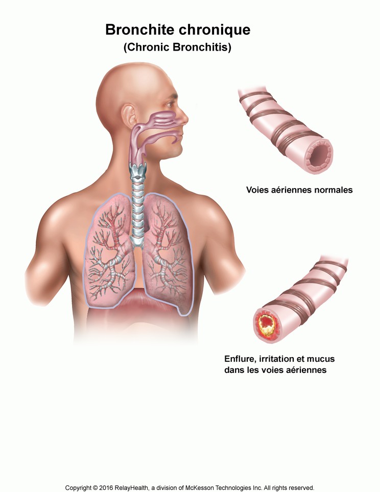 Chronic Bronchitis: Illustration