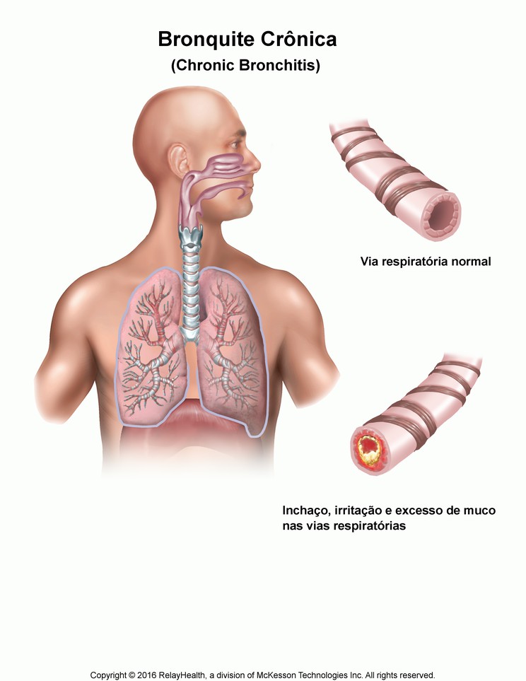 Chronic Bronchitis: Illustration
