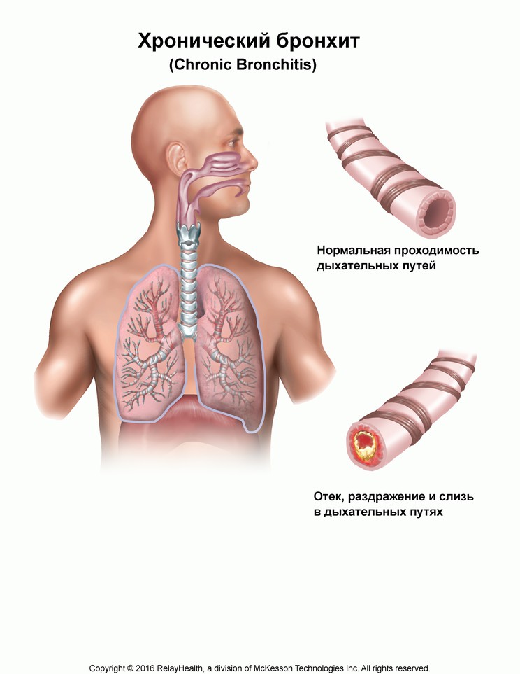 Chronic Bronchitis: Illustration