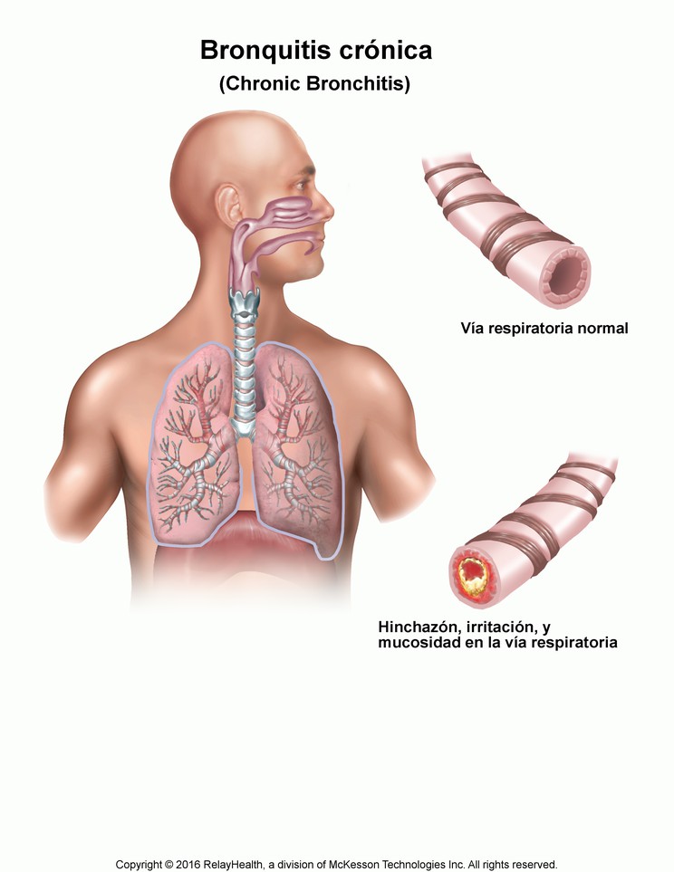 Chronic Bronchitis: Illustration