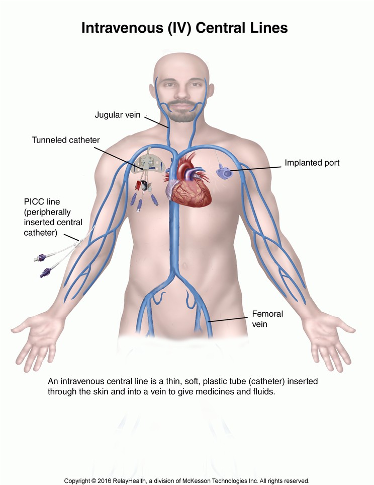 Intravenous (IV) Central Lines: Illustration