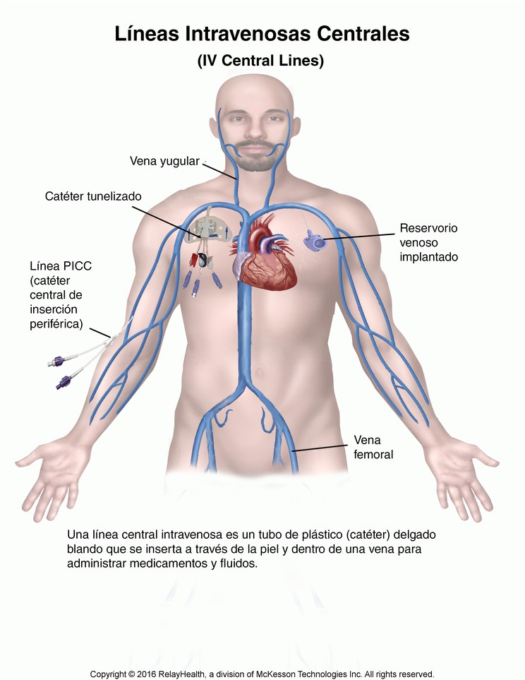 Intravenous (IV) Central Lines: Illustration