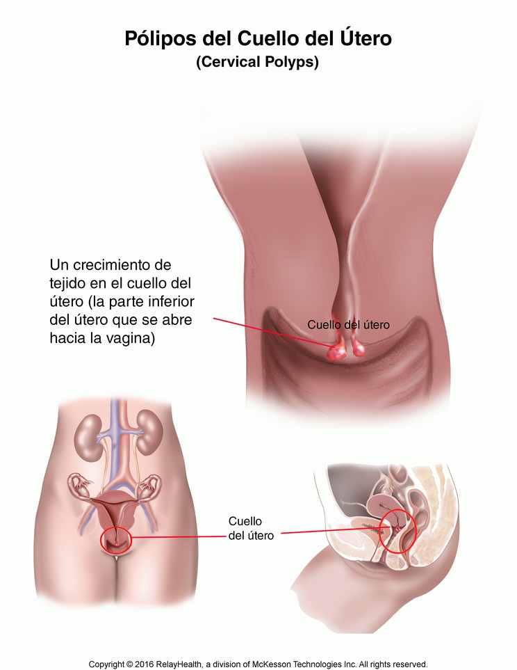 Cervical Polyps: Illustration