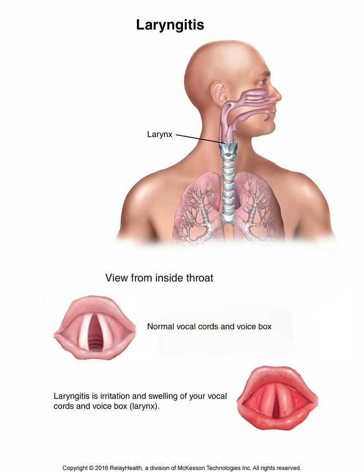 Laryngitis: Illustration