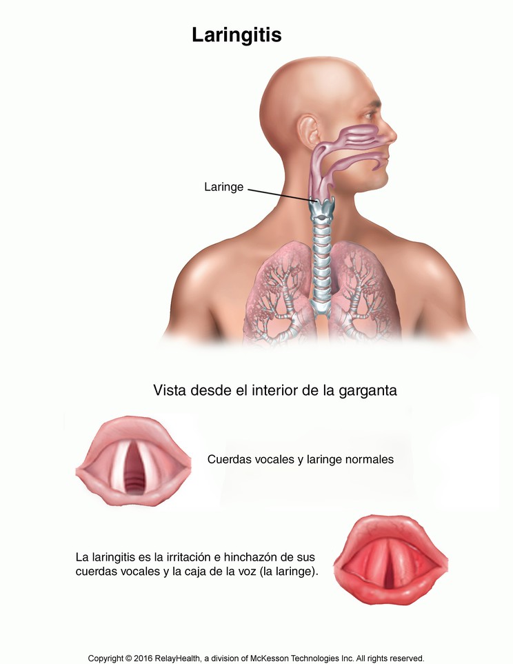 Laryngitis: Illustration