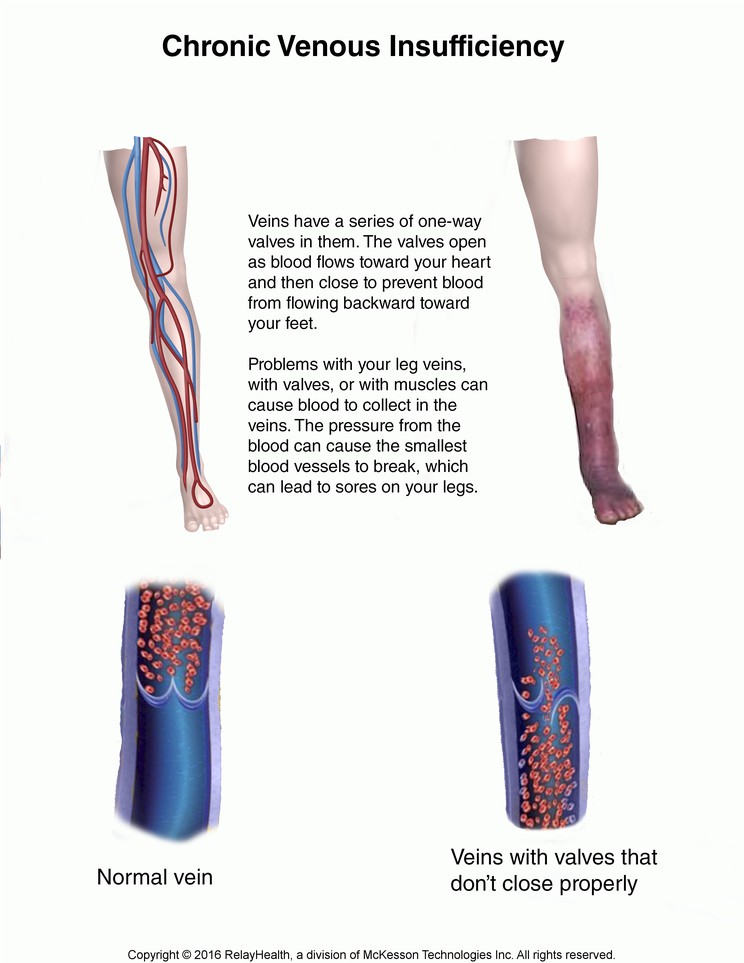 Chronic Venous Insufficiency: Illustration
