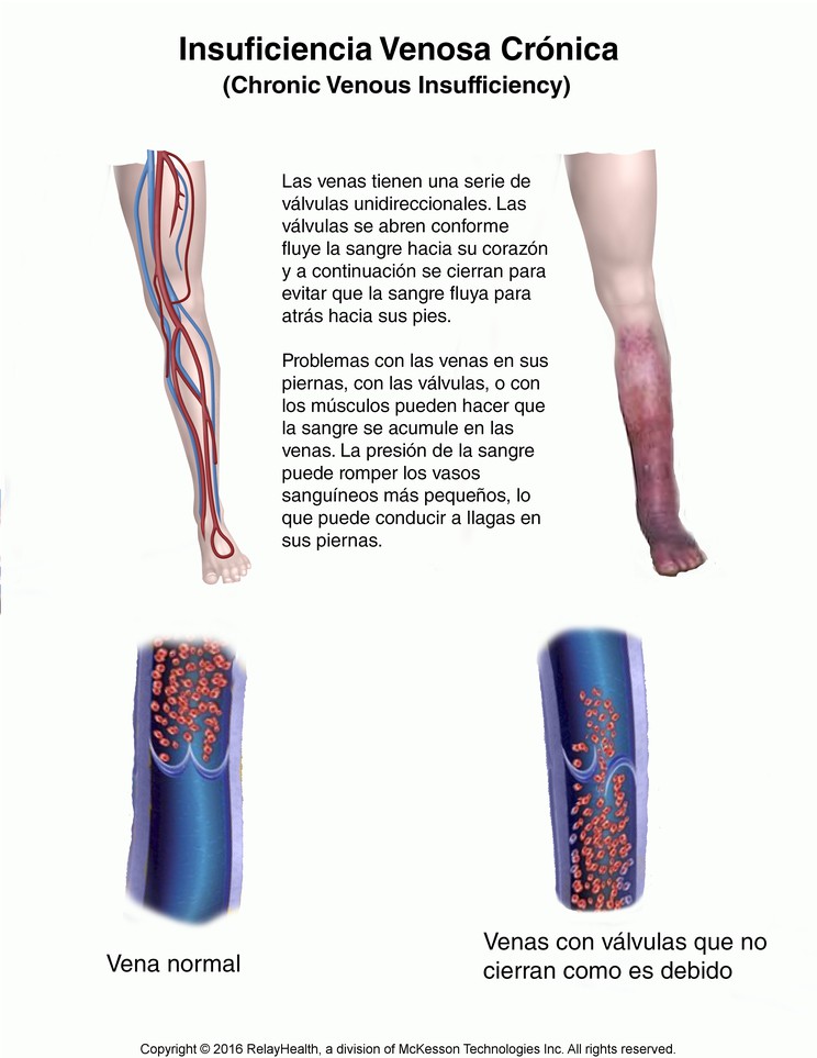 Chronic Venous Insufficiency: Illustration