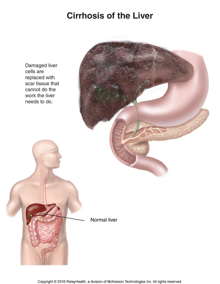 Cirrhosis: Illustration