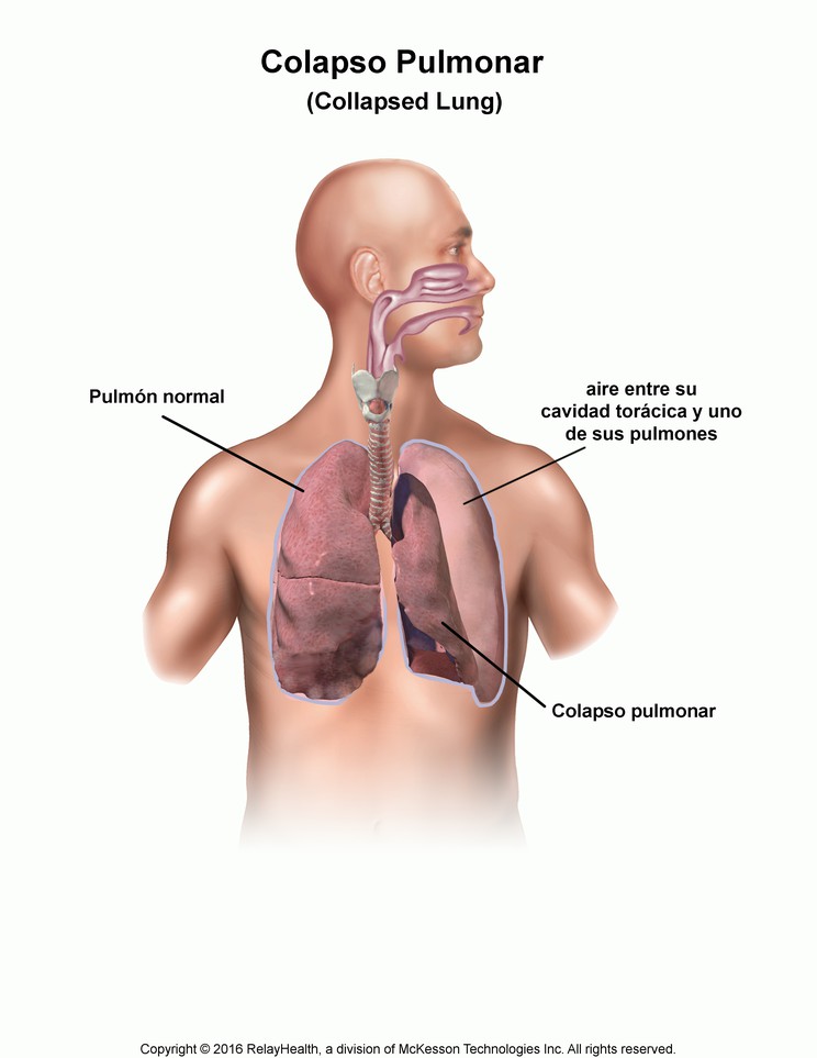 Collapsed Lung: Illustration