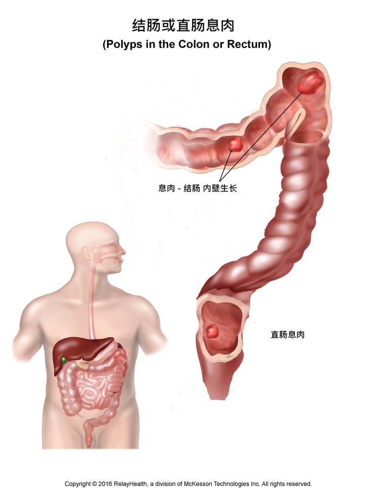 Polyps in the Colon or Rectum: Illustration