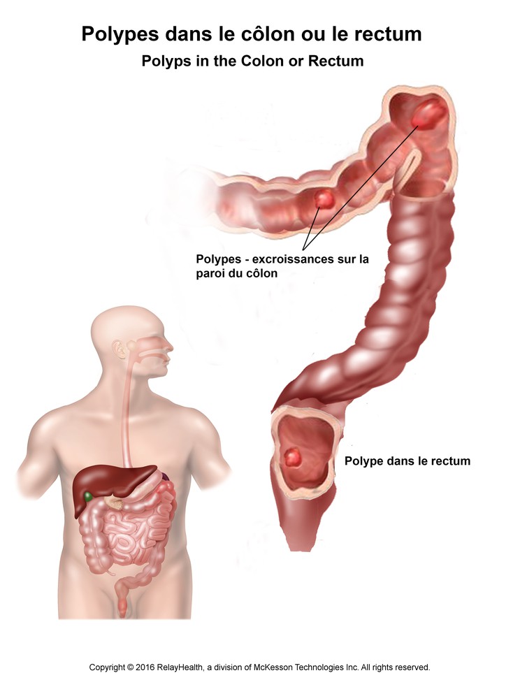 Polyps in the Colon or Rectum: Illustration