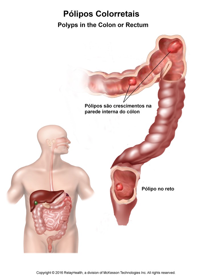 Polyps in the Colon or Rectum: Illustration