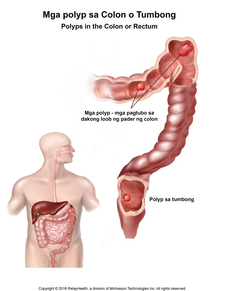 Polyps in the Colon or Rectum: Illustration