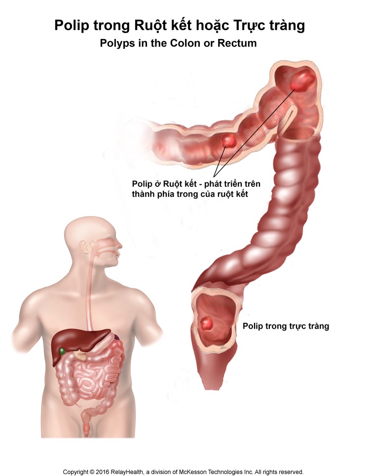 Polyps in the Colon or Rectum: Illustration