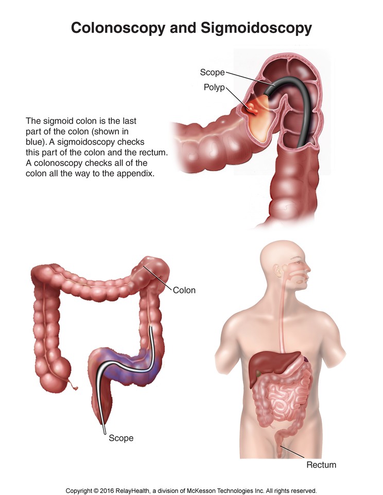 Colonoscopy and Sigmoidoscopy: Illustration
