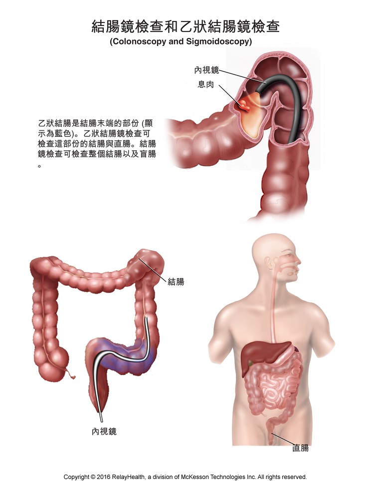 Colonoscopy and Sigmoidoscopy: Illustration