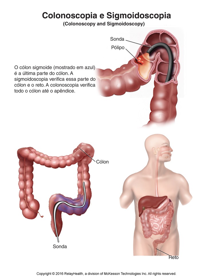 Colonoscopy and Sigmoidoscopy: Illustration