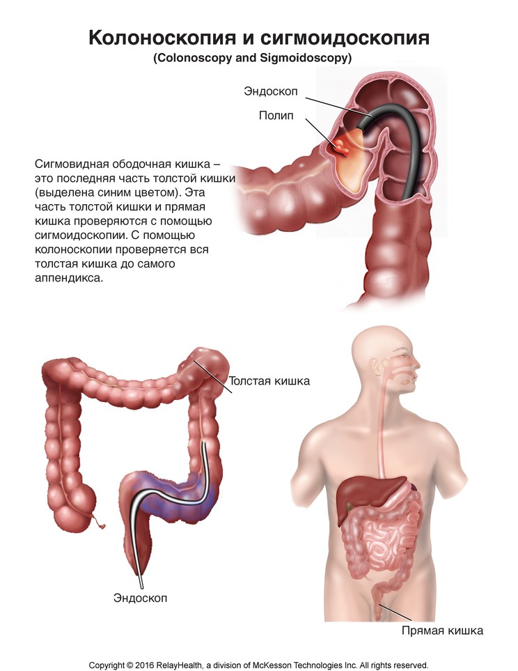Colonoscopy and Sigmoidoscopy: Illustration