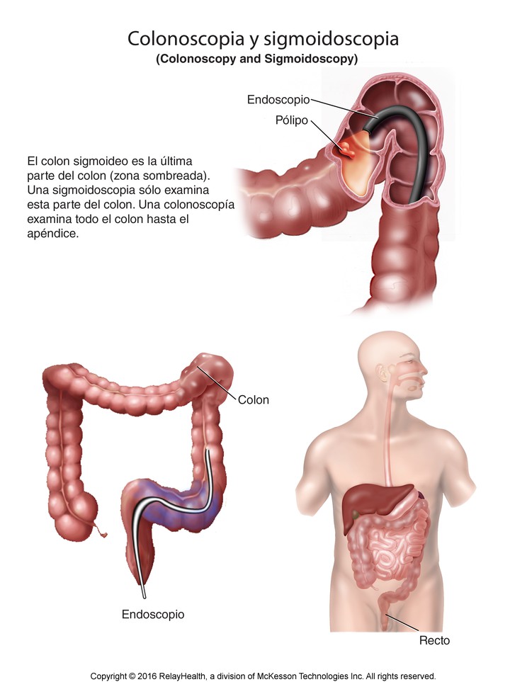 Colonoscopy and Sigmoidoscopy: Illustration