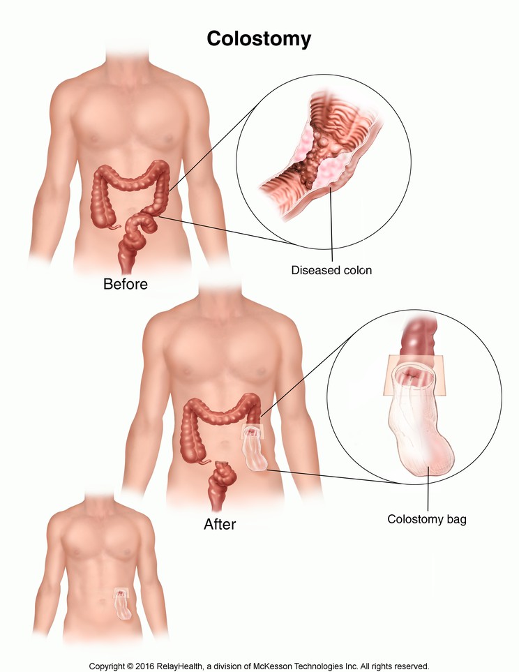 Colostomy: Illustration