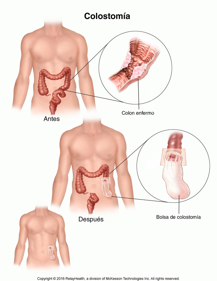 Colostomy: Illustration