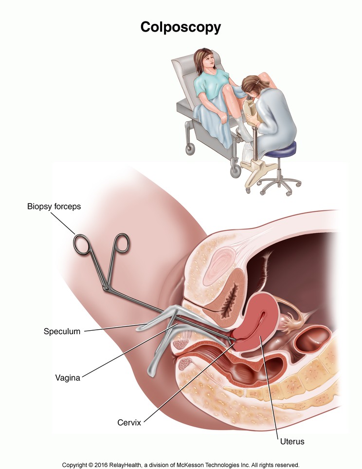 Colposcopy: Illustration