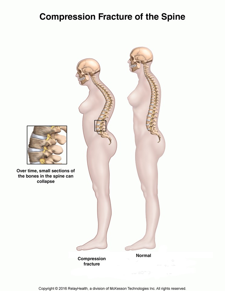 Compression Fracture of the Spine: Illustration