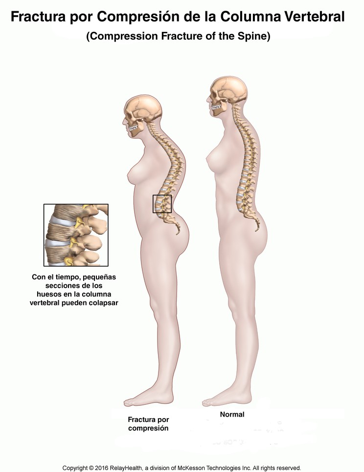 Compression Fracture of the Spine: Illustration