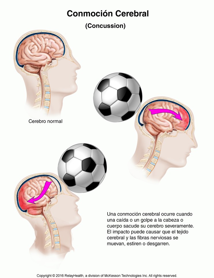 Concussion: Illustration