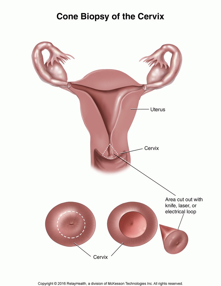 Cone Biopsy of the Cervix: Illustration