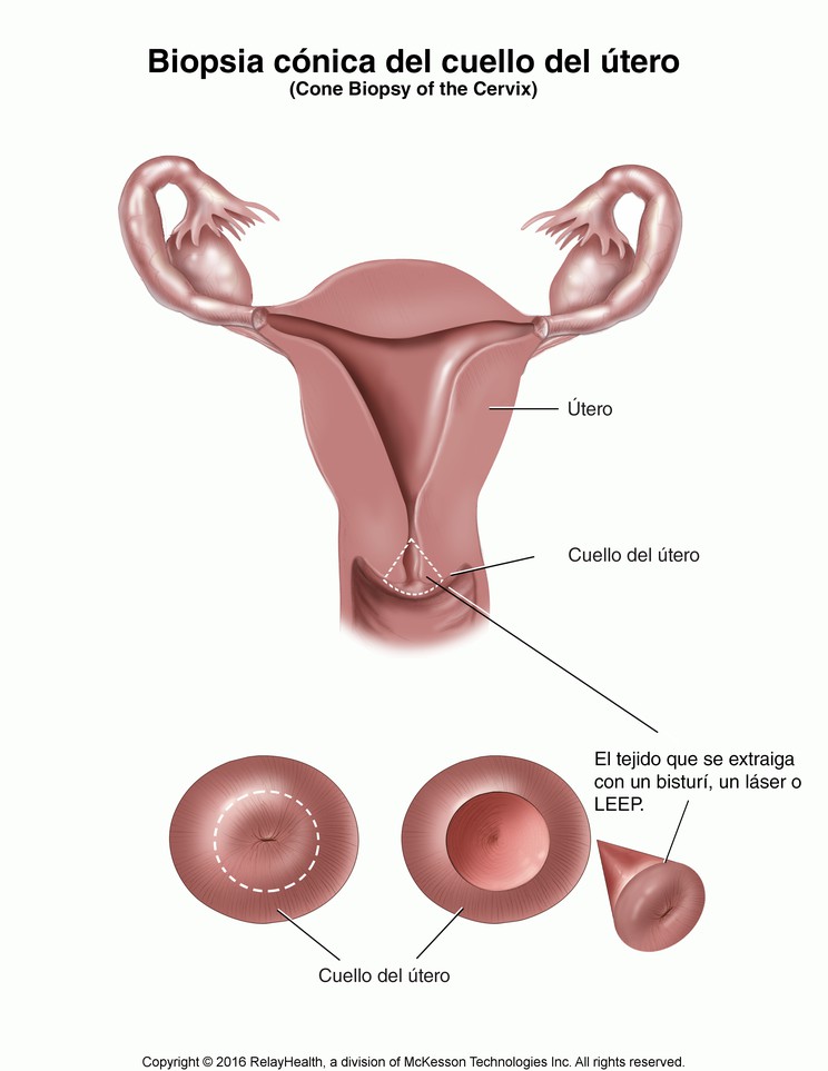 Cone Biopsy of the Cervix: Illustration