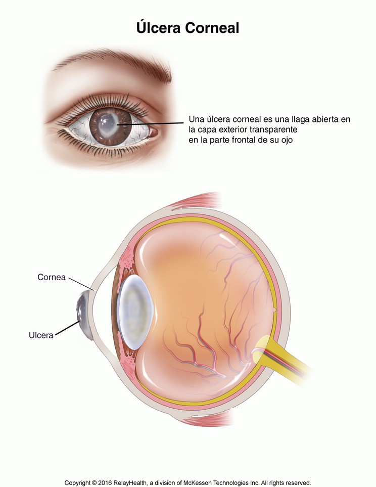 Corneal Ulcer: Illustration