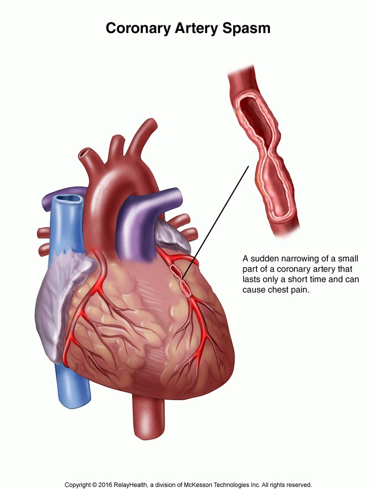 Coronary Artery Spasm: Illustration