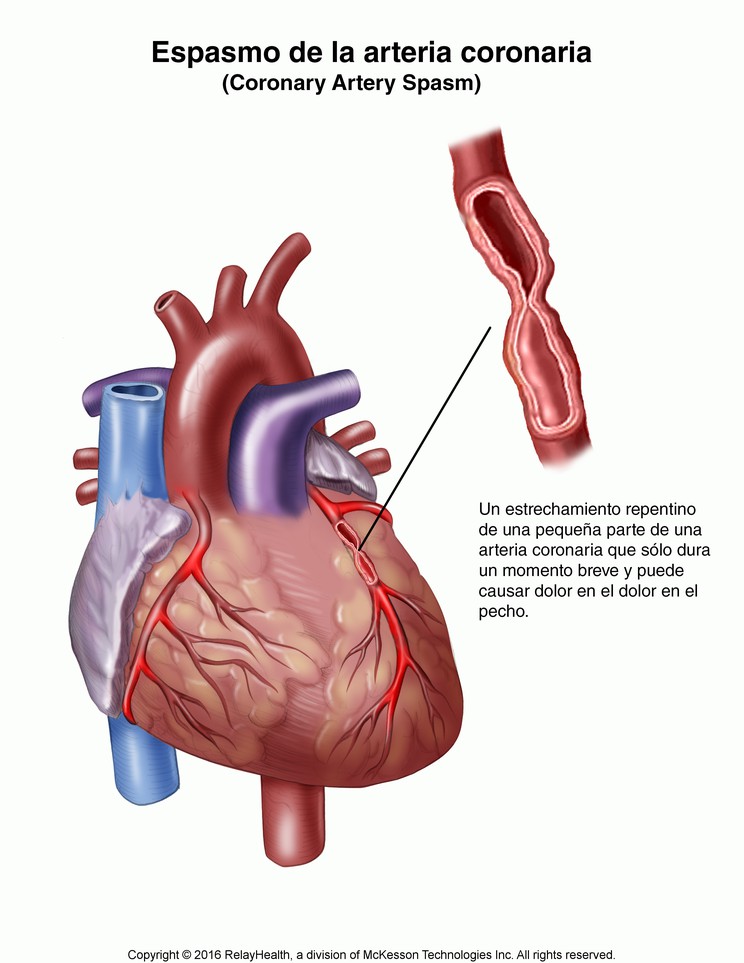 Coronary Artery Spasm: Illustration