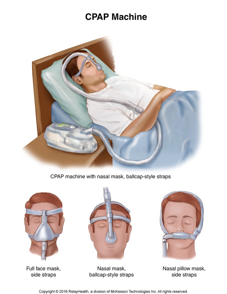 CPAP Machine: Illustration