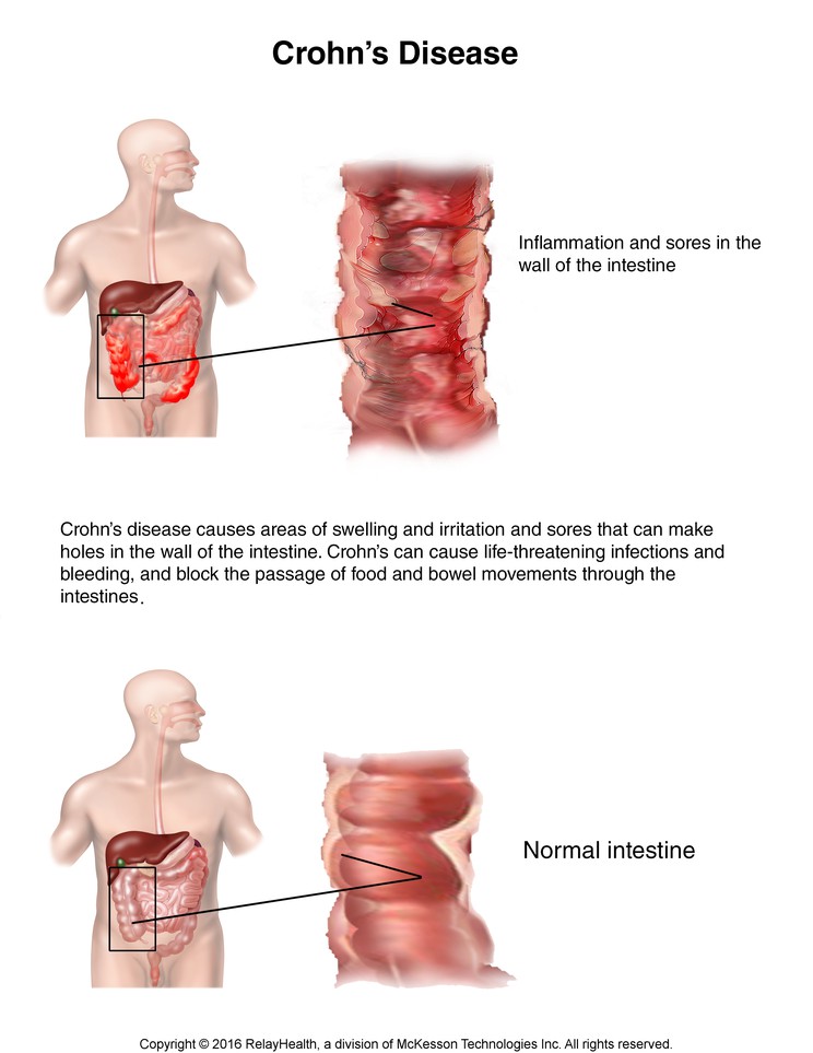 Crohn's Disease: Illustration