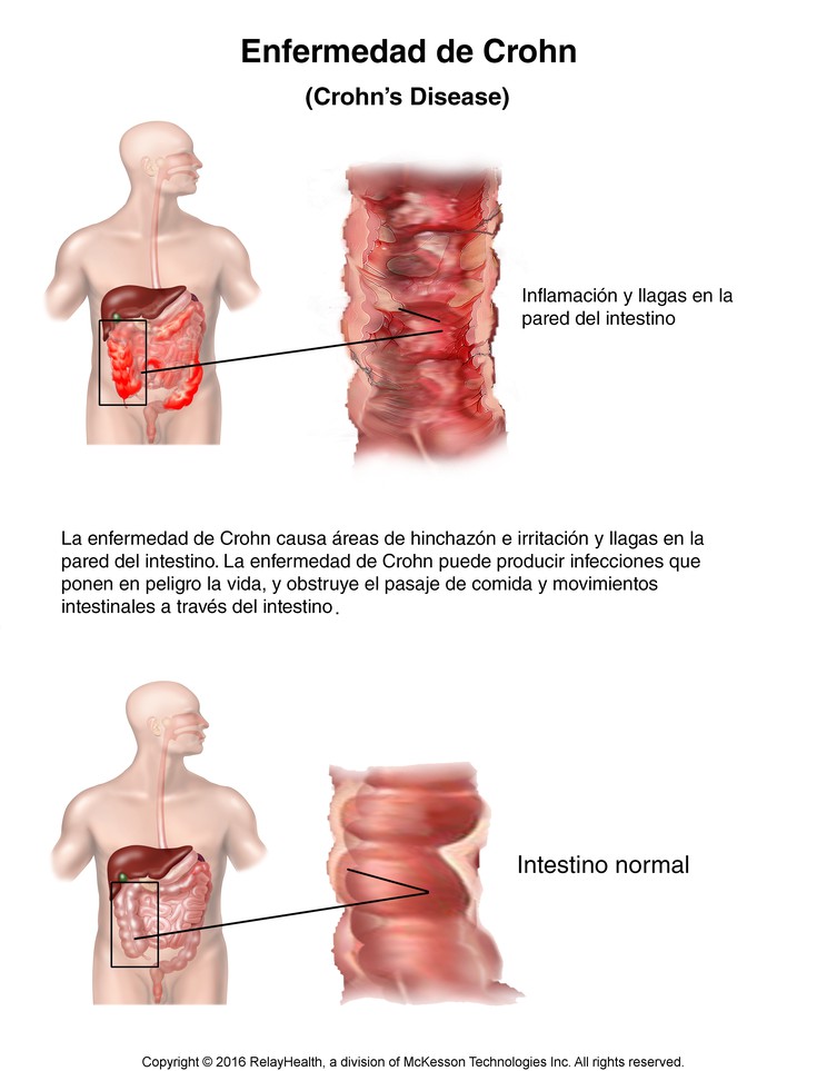 Crohn's Disease: Illustration