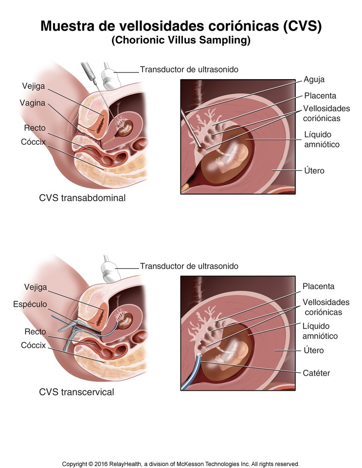 Chorionic Villus Sampling (CVS): Illustration
