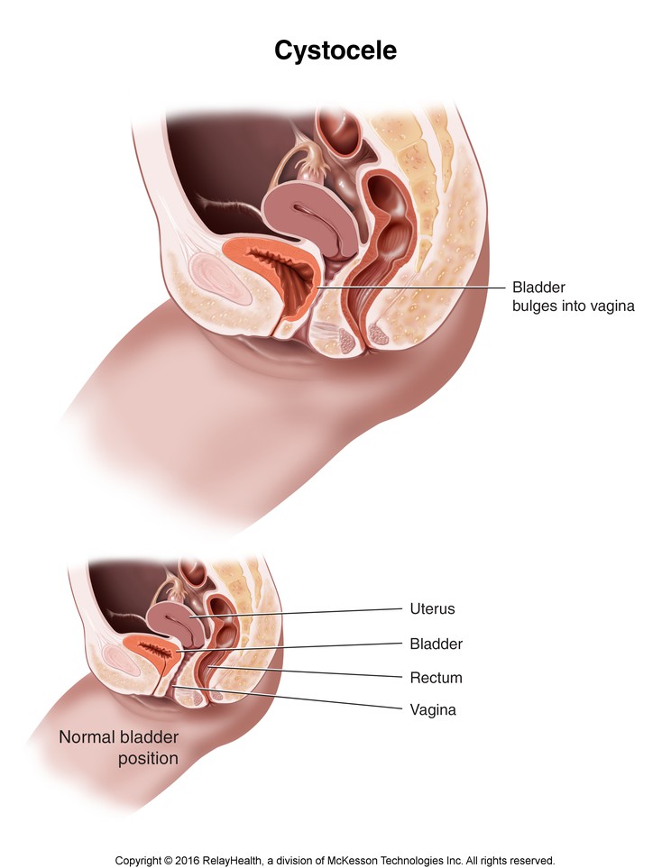 Cystocele: Illustration