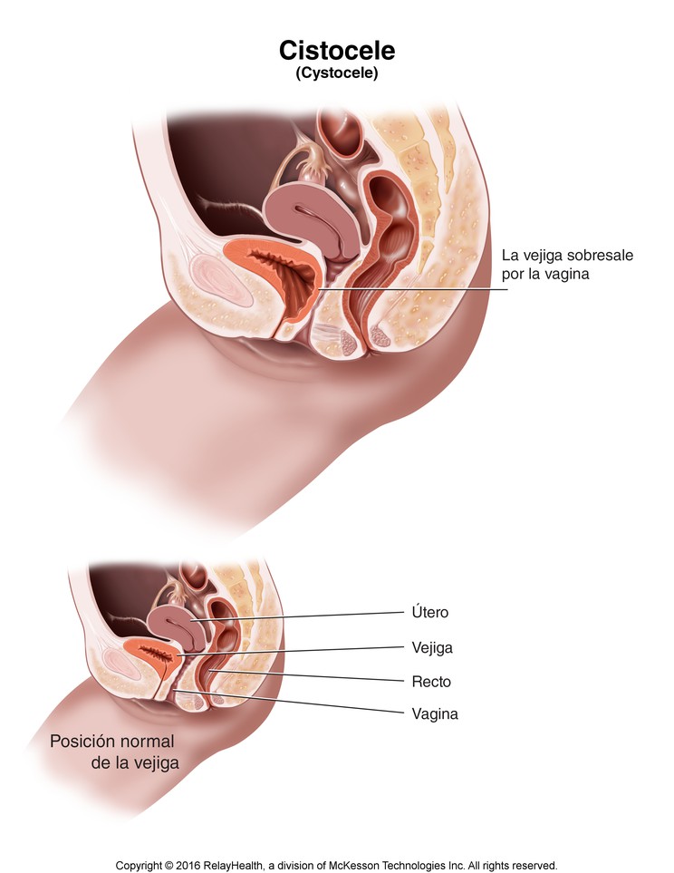 Cystocele: Illustration