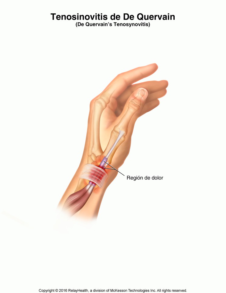 De Quervain's Tenosynovitis: Illustration